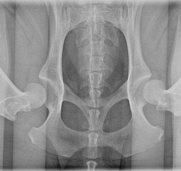 X-ray image of a human pelvis and hip joints, vet-reviewed, showing bones with clear outlines and internal pelvic structures.